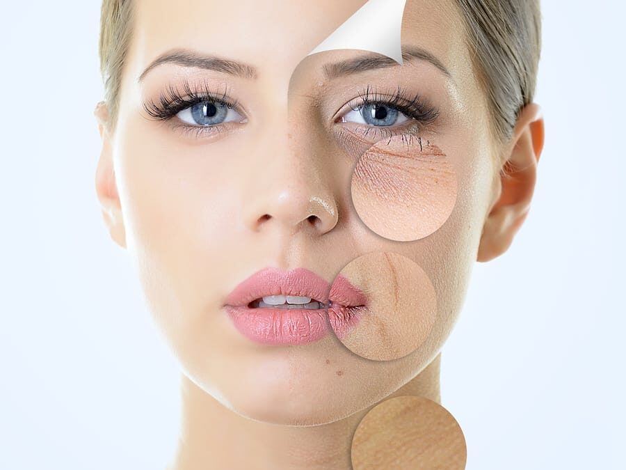 What is Micro-Needling?