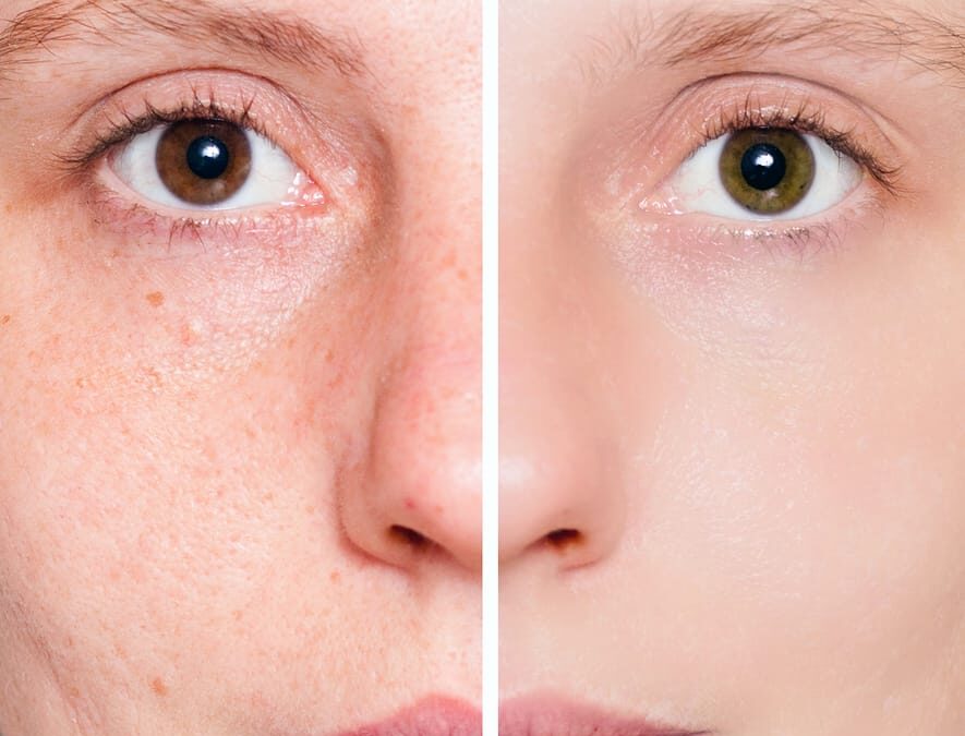 Looking into Freckle Removal