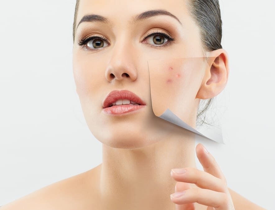 Find Acne Relief with PCA Skin Oxygenating Facial