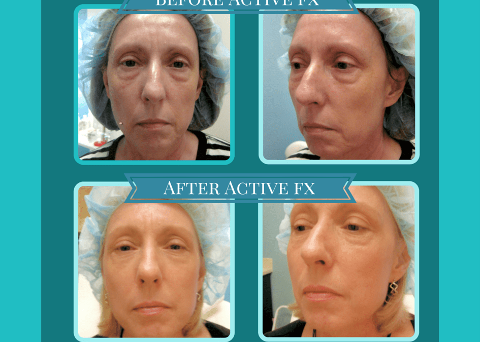 Erase the Impact of Skin Damage with Active FX Laser Resurfacing