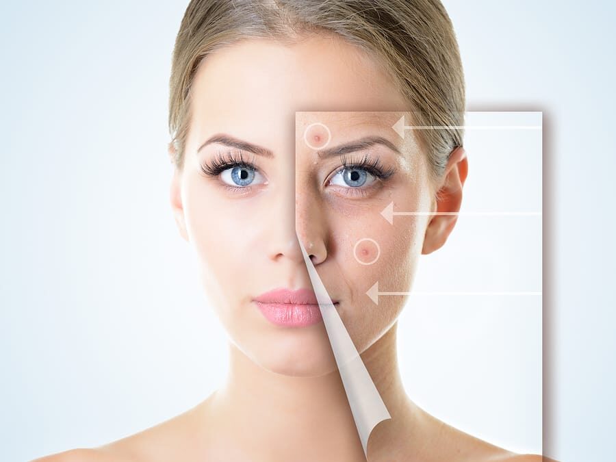 Best Way to Treat Acne Scars