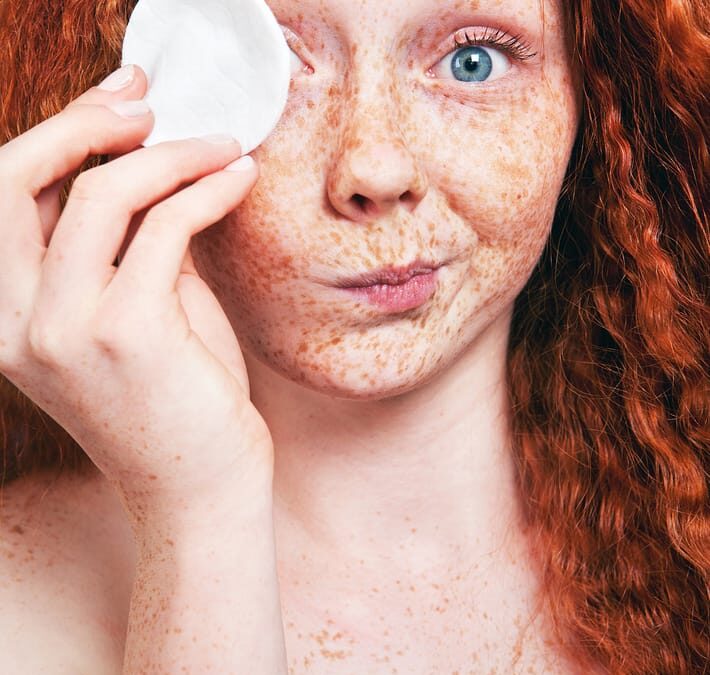 Best Treatments to Diminish Freckles