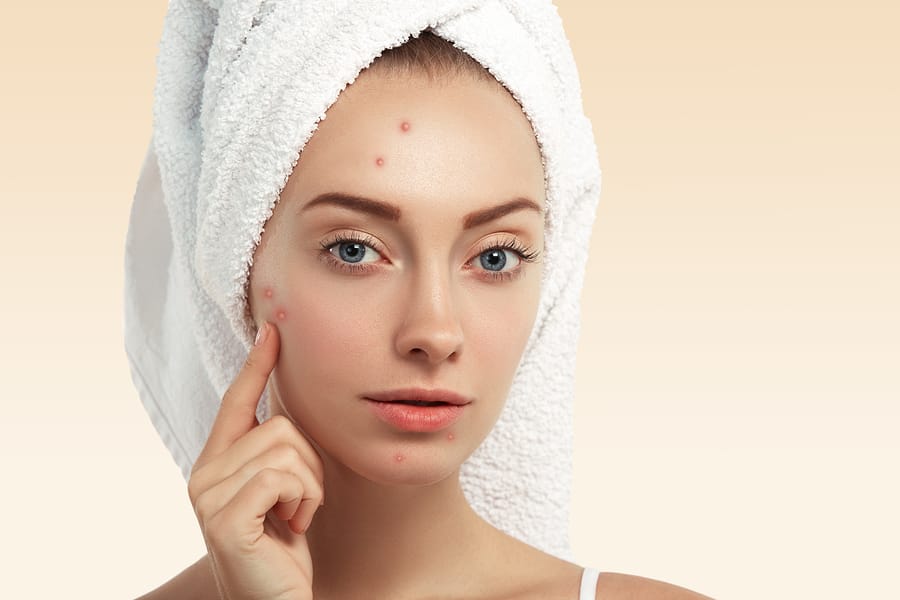 Our Favorite Acne Treatments