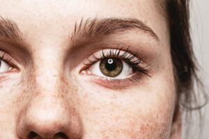Best Treatments for Freckle Removal