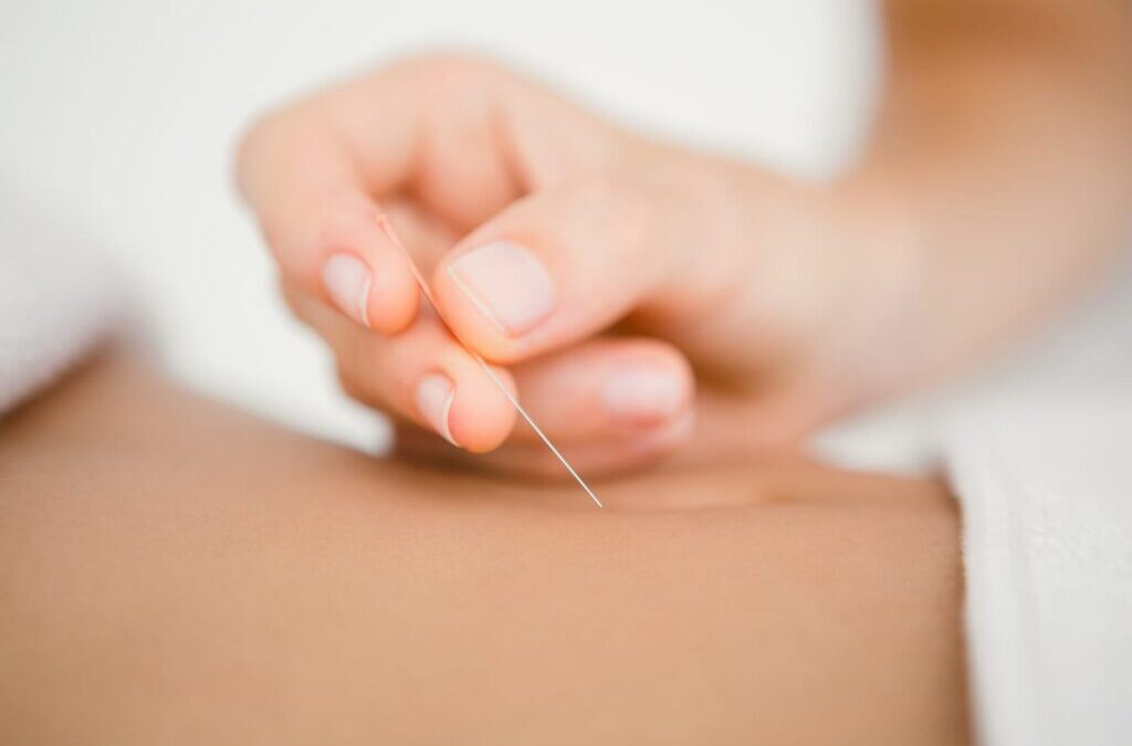 Acupuncture to Treat Pain
