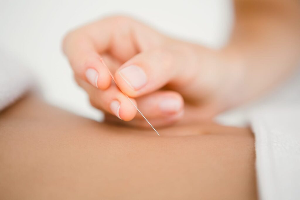 acupuncture-for-pain