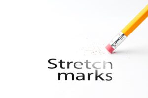 How Can I Get Rid of Stretch Marks?