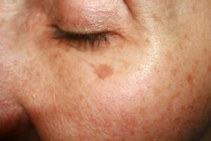 What Causes Hyperpigmentation and How Can It Be Treated?