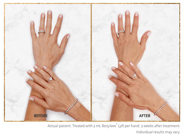Hand Rejuvenation with Restylane Lyft 