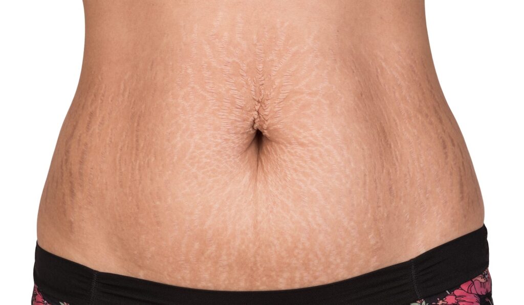 Are Stretch Marks Permanent? 