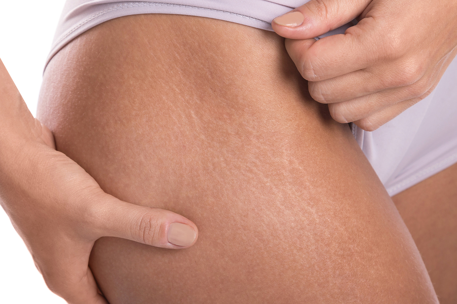 Stretch Mark Micro Needling, Smoothen the scars