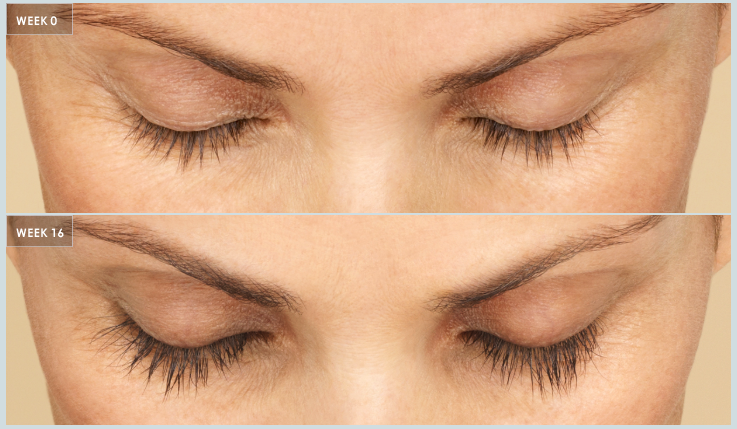 What is the Best Treatment for Thinning Eye Lashes