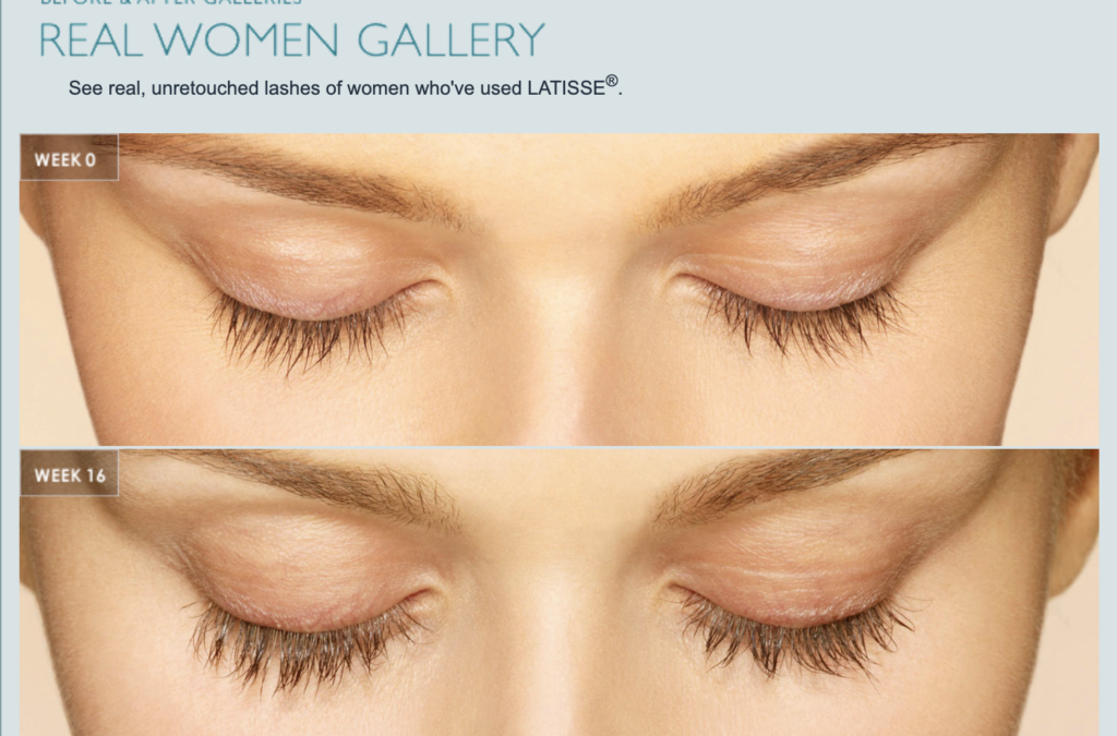 Why Choose Latisse Over Other Eyelash Growth Products