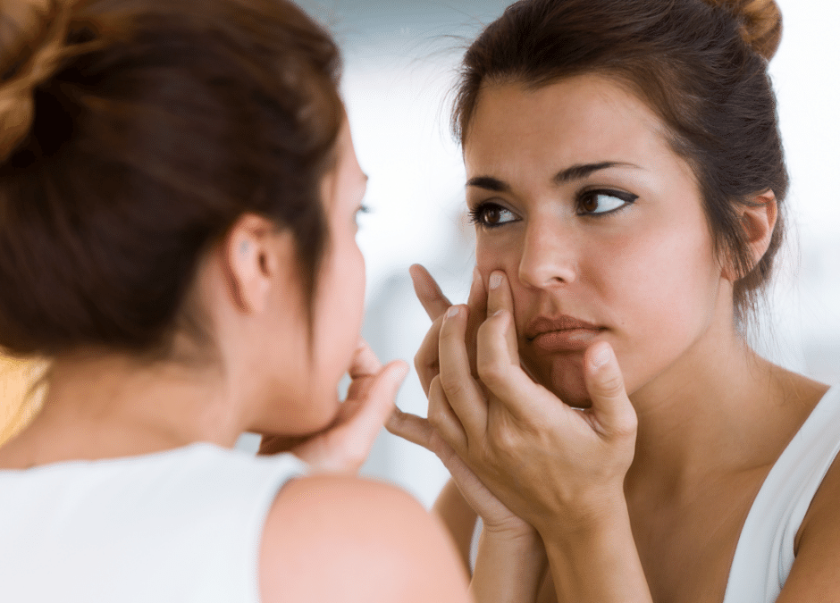 3 Tips to Combat Adult Acne