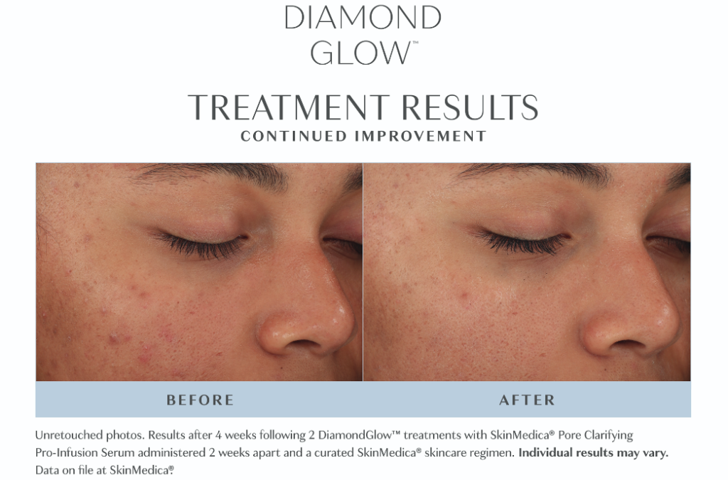 3 Reasons We Love DiamondGlow Treatments