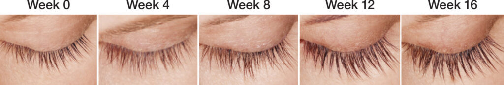 Thinning Eyelashes? Latisse is the Answer