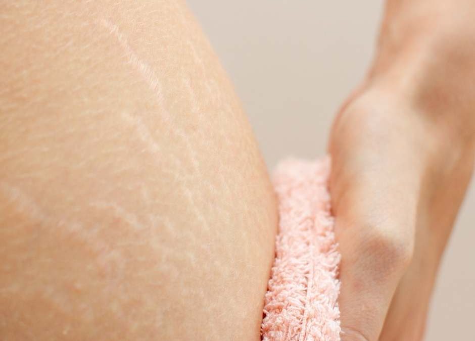 Top Treatments for Stretch Marks