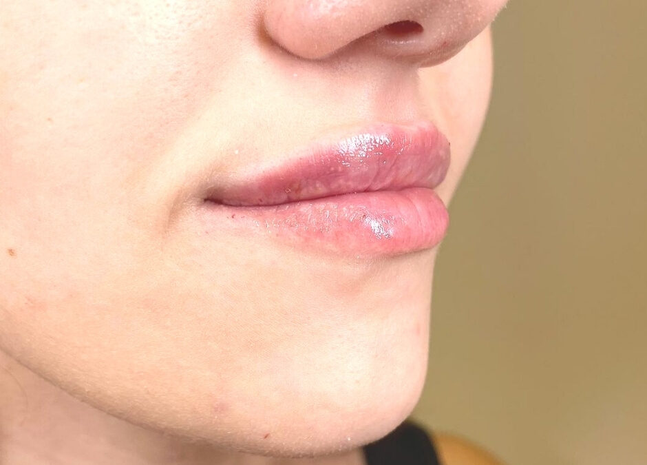 What to Expect After Getting Lip Fillers