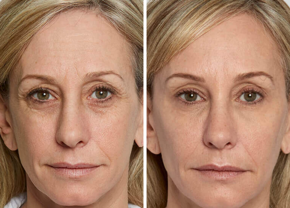 Take 10 Years Off Your Face With Sculptra