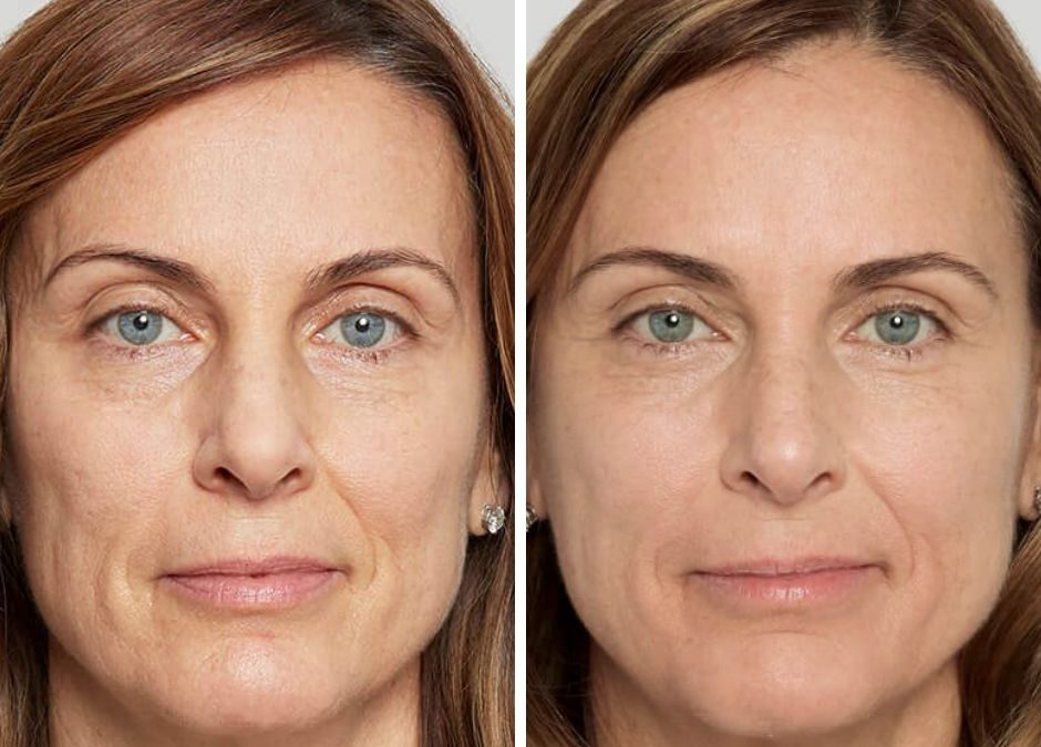 Rid Your Face of Smile Lines with Sculptra Aesthetic