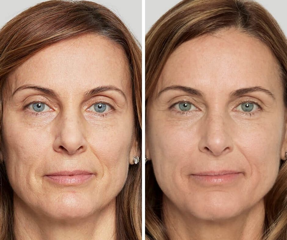Rid Your Face Of Smile Lines With Sculptra Aesthetic The Skin Clinic