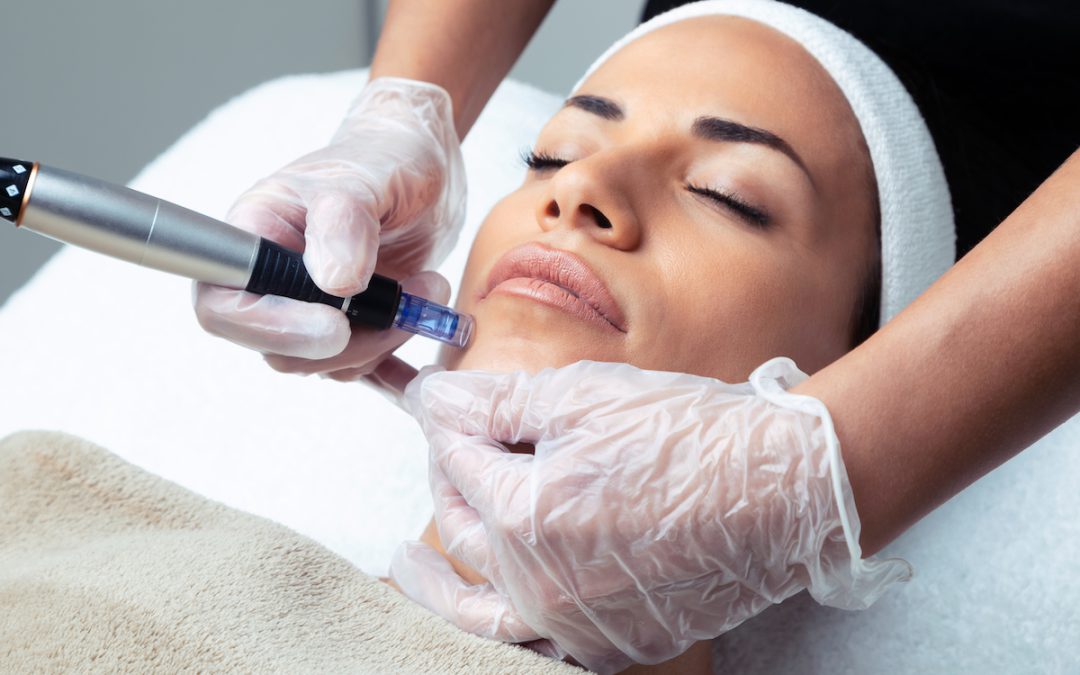 3 Benefits of Microneedling