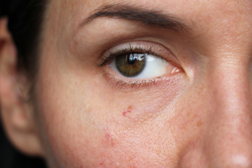 How to Get Rid of Spider Veins on Your Face