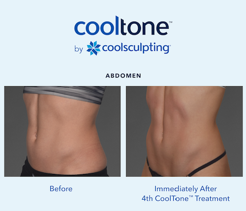 Cooltone-by coolsculpting-skin-clinic-scottsdale
