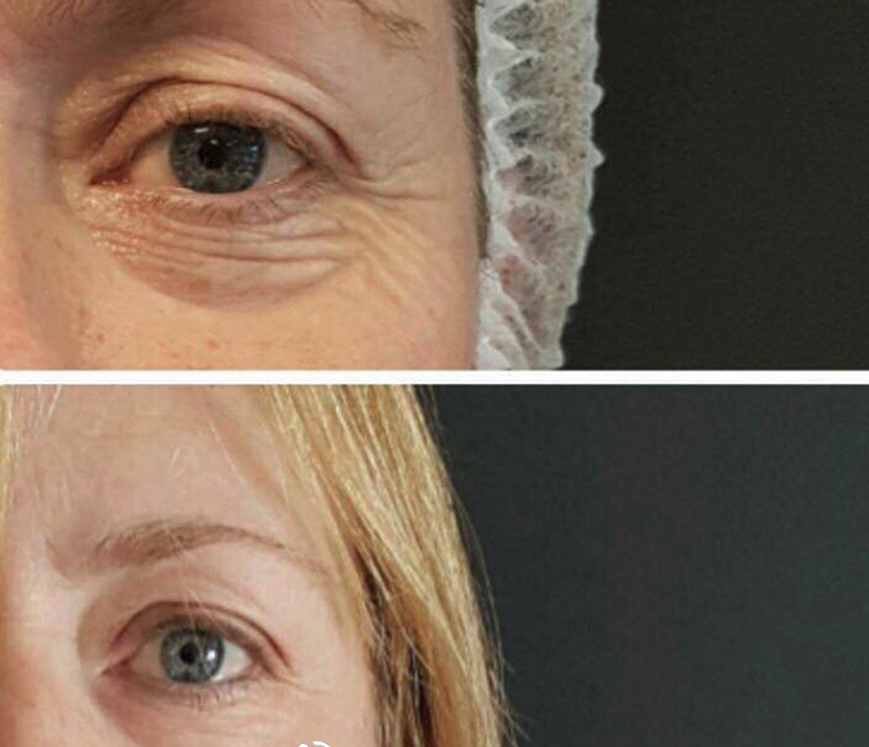 Skip the Surgery and Get an Eye Lift With Plasma Pen Instead