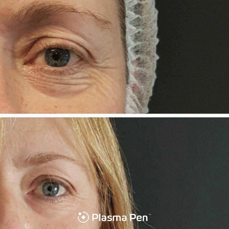 plasma-pen-eyelift