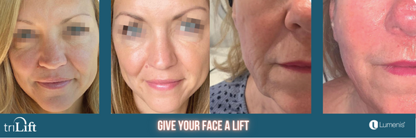 Introducing triLift: Achieve a Facelift Effect Without Surgery