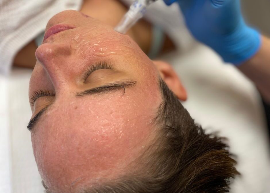 How Should I Care for My Skin After a MicroNeedling Treatment?