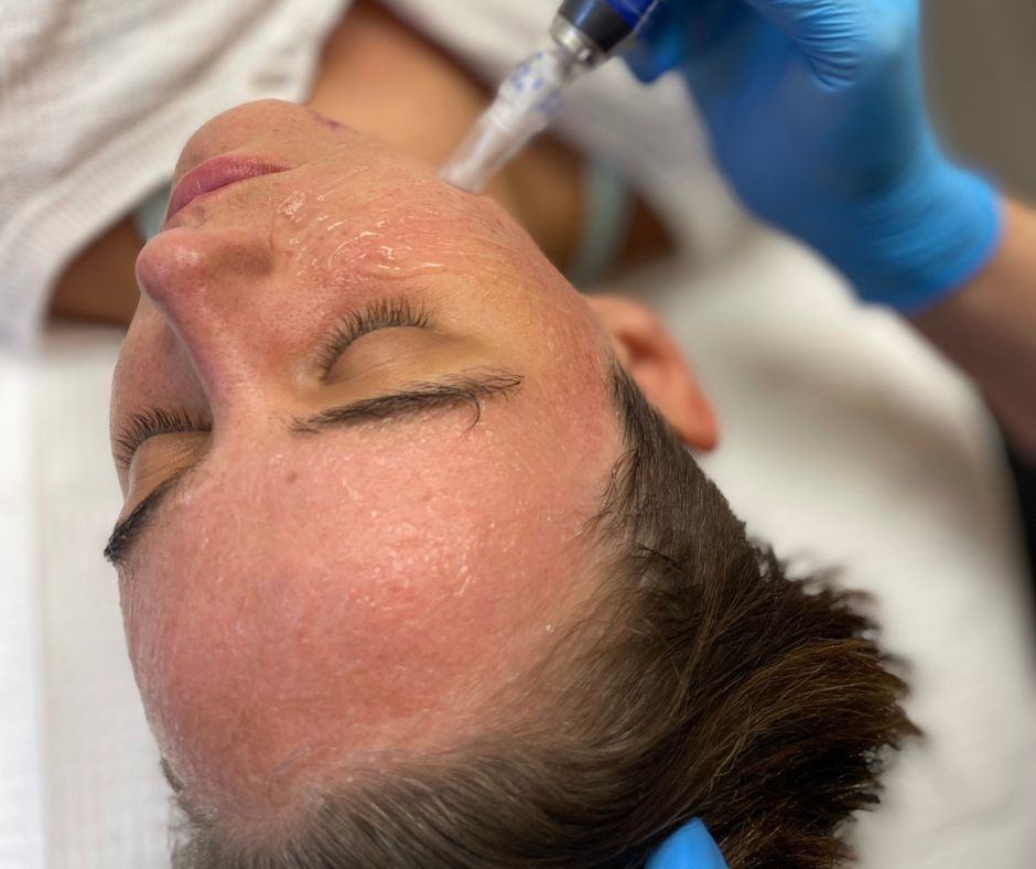 How Should I Care for My Skin After a MicroNeedling Treatment?