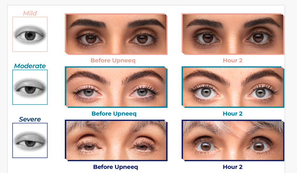 Use UPNEEQ for a Non Surgical Eye Lift