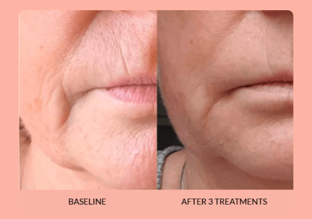What is the Best Non-Surgical Facelift?