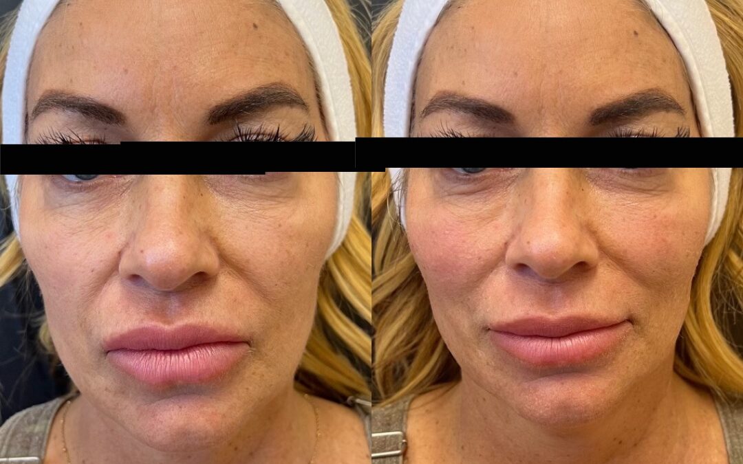 Best non-surgical facelift for Jawline, Cheeks and Wrinkles