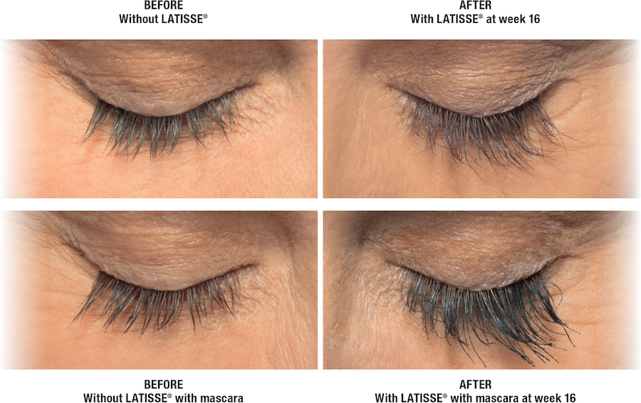 FDA Approved Latisse is the Only Product Proven Effective for Eyelash Growth and Thickness
