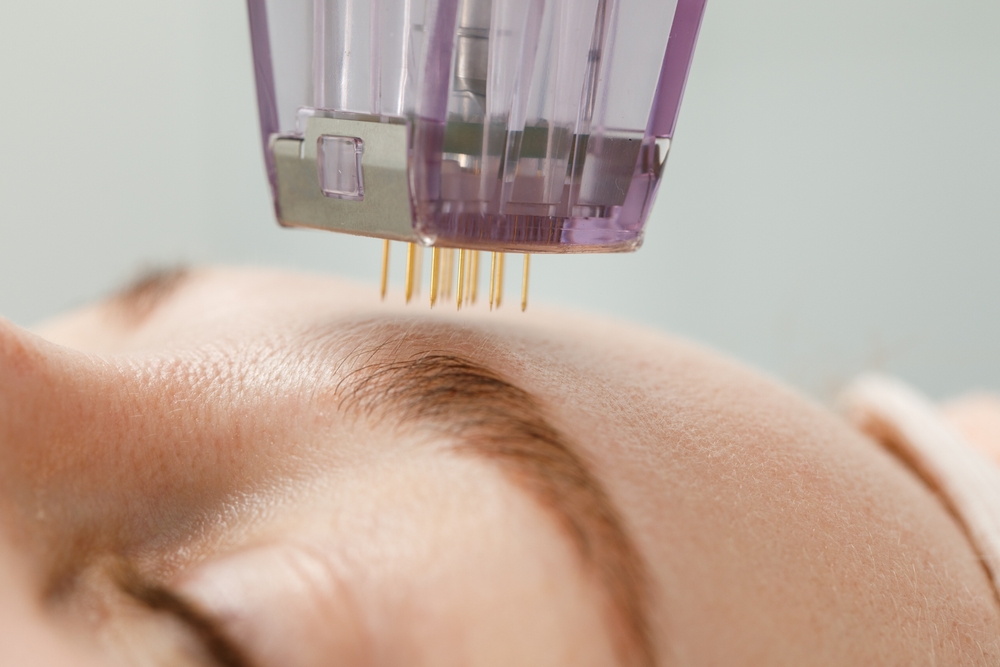 How Does Microneedling Work?