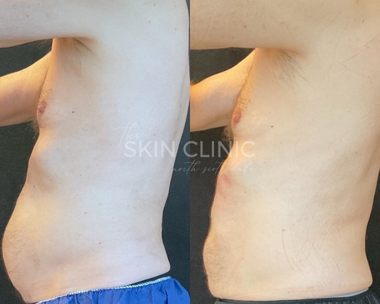 Before-and-After-CoolSculpting-Treatment-Skin-Clinic-Scottsdale