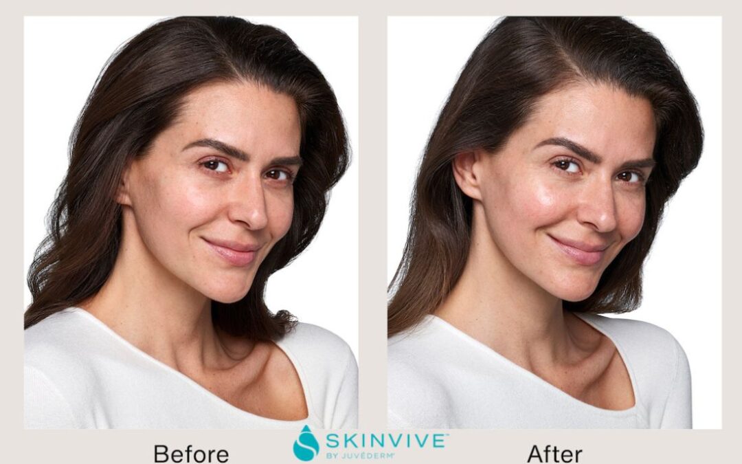Introducing Skinvive by Juvederm