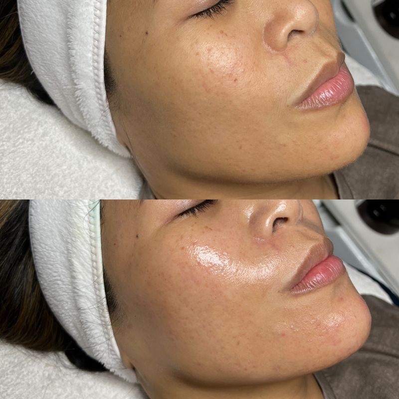 glow-glace-facial-smooth-tone-remove-wrinkles