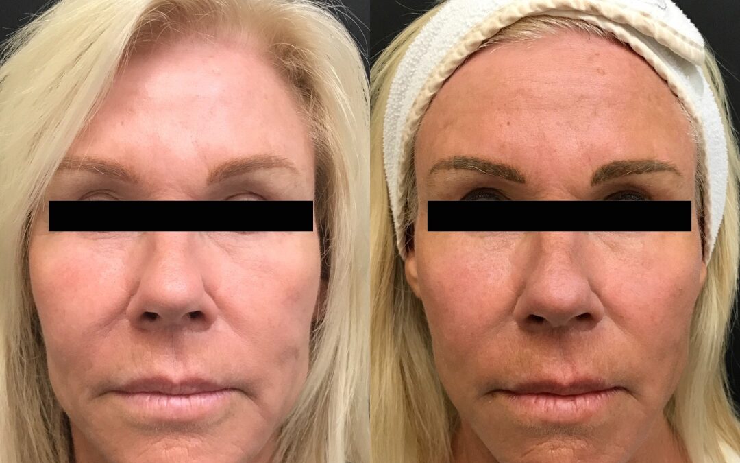 triLift – The Nonsurgical Face Lift You’ve Been Dreaming Of