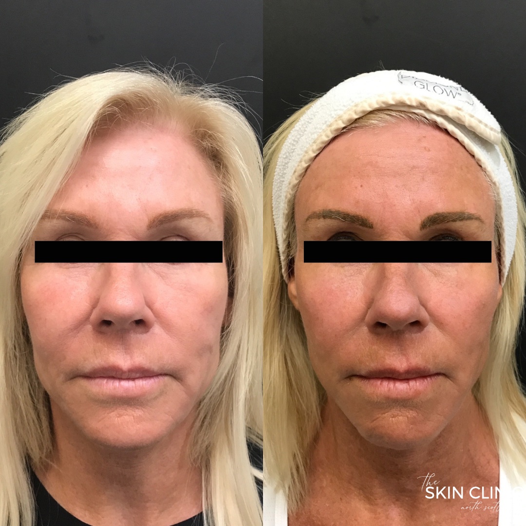 nonsurgical-trilift-facelift-scottsdale