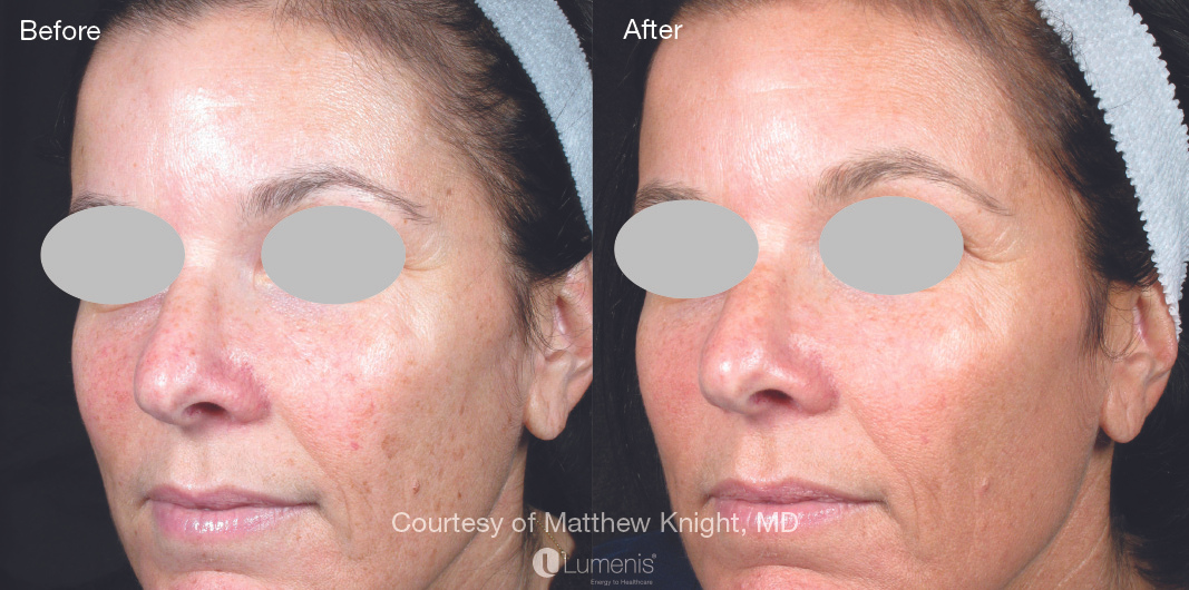 M22 Photofractional-treatment-advanced-skin-rejuvenation