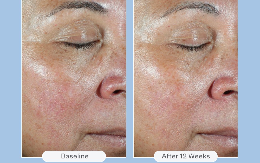Product of the Month: HA5® Hydra Collagen Replenish + Restore Hydrator by SkinMedica