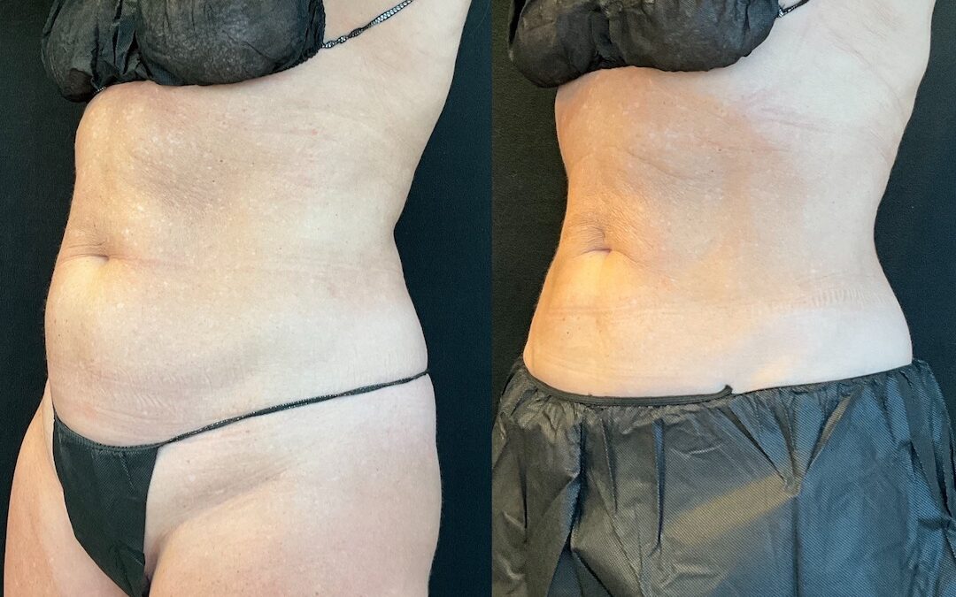 Transform Your Body With CoolSculpting Elite and Semaglutide