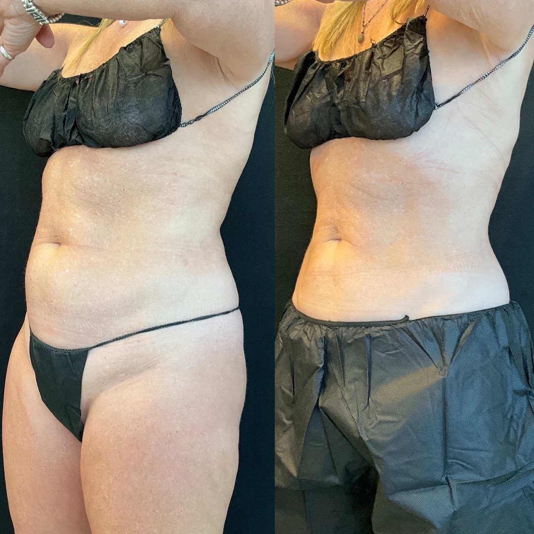 coolsculpting-scottsdale