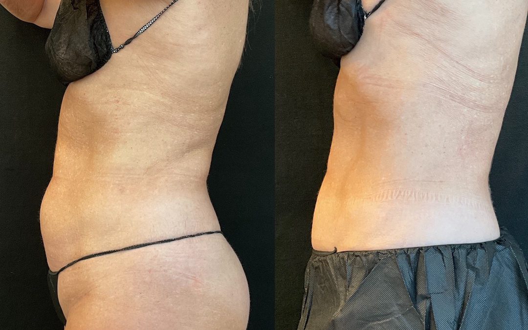 How Does CoolSculpting Work to Eliminate Stubborn Fat?