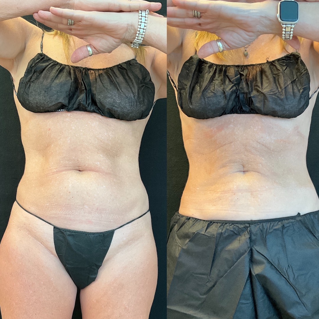 coolsculpting-scottsdale-before-and-after