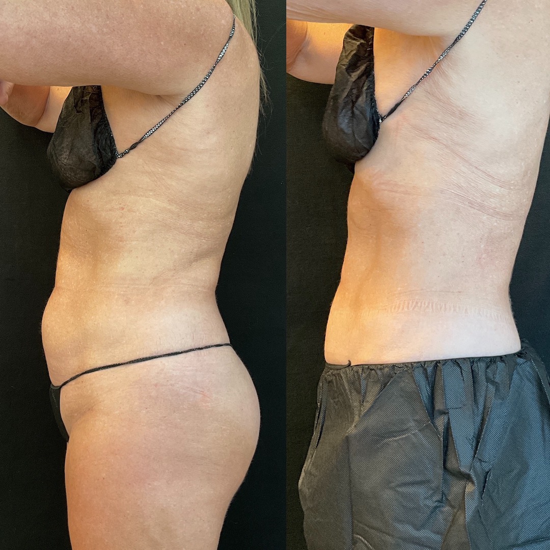 coolsculpting-and-semaglutide-scottsdale